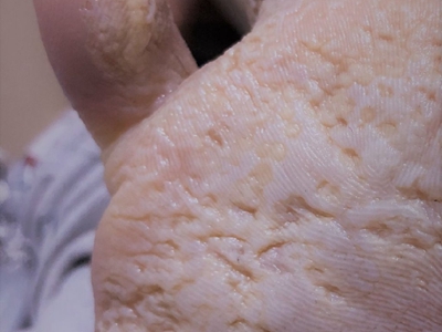 窩狀角質松解症腳底皮膚發白有小坑圖