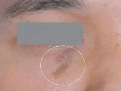 咖啡斑眼睛旁邊有不規則的咖啡色斑圖 咖啡斑眼睛旁邊有不規則的咖啡色斑圖