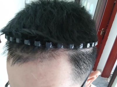 雄激素性脫髮髮際線後退像M型一樣圖 雄激素性脫髮髮際線後退像M型一樣圖