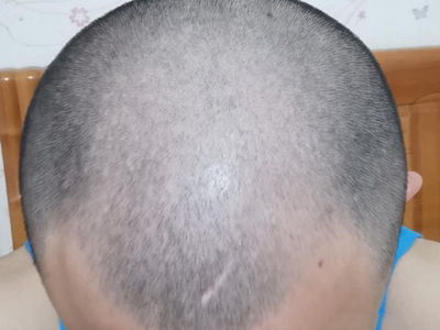 雄激素性脫髮額頭兩邊頭髮掉沒了圖 雄激素性脫髮額頭兩邊頭髮掉沒了圖