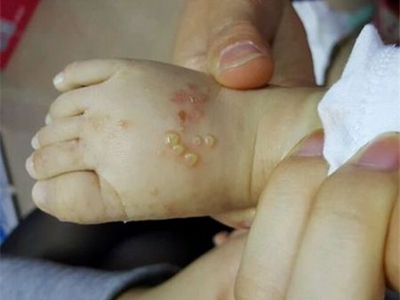 新生兒膿皰瘡腳背有幾個黃色膿包圖 新生兒膿皰瘡腳背有幾個黃色膿包圖
