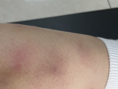 硬結性紅斑小腿上好幾片紫紅色結節圖 硬結性紅斑小腿上好幾片紫紅色結節圖