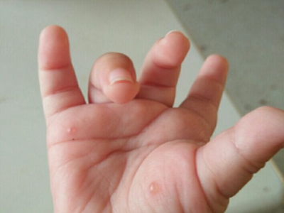 嬰兒肢端膿皰病手掌有兩個透明水皰圖 嬰兒肢端膿皰病手掌有兩個透明水皰圖