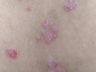 尋常型銀屑病後背長紅色疙瘩還脫皮圖