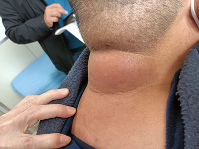 硬腫病後頸部腫脹凸起圖 硬腫病後頸部腫脹凸起圖