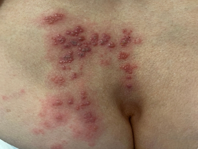 愛滋病感染性皮膚損害臀部好多水皰圖 愛滋病感染性皮膚損害臀部好多水皰圖