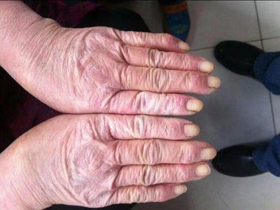 手部濕疹雙手手背及手指處紅色腫脹圖 手部濕疹雙手手背及手指處紅色腫脹圖