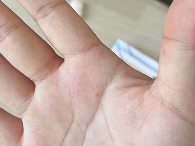 手部濕疹右手手掌有淡紅色的小疙瘩圖 手部濕疹右手手掌有淡紅色的小疙瘩圖