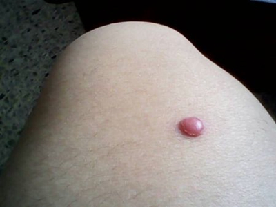 小汗腺汗孔瘤大腿上有個紅色圓疙瘩圖 小汗腺汗孔瘤大腿上有個紅色圓疙瘩圖