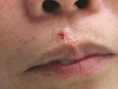 硬化性汗腺導管癌嘴唇上面有小疙瘩圖 硬化性汗腺導管癌嘴唇上面有小疙瘩圖