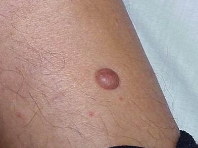 皮膚纖維瘤大腿上長了個圓形肉疙瘩圖 皮膚纖維瘤大腿上長了個圓形肉疙瘩圖