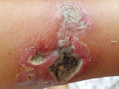 糖尿病性皮膚病胳膊上傷口紅腫流膿圖 糖尿病性皮膚病胳膊上傷口紅腫流膿圖
