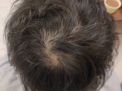 雄激素性脫髮頭頂頭髮稀疏微禿圖