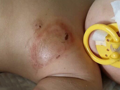 新生兒膿皰瘡左胸上方有色素沉著斑圖 新生兒膿皰瘡左胸上方有色素沉著斑圖