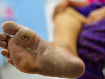 糖尿病性皮膚病腳底爛了一塊並結痂圖 糖尿病性皮膚病腳底爛了一塊並結痂圖