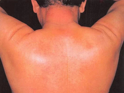 硬腫病背部腫了僵硬圖