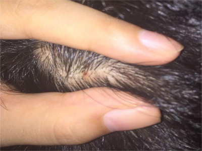疣狀角化不良瘤頭皮淡黃褐色小疙瘩圖