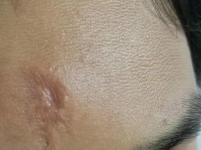 萎縮性瘢痕前額有一塊凹陷瘢痕圖 萎縮性瘢痕前額有一塊凹陷瘢痕圖