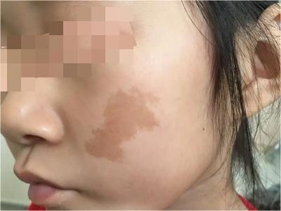 咖啡斑臉上有不規則的深棕色斑圖 咖啡斑臉上有不規則的深棕色斑圖