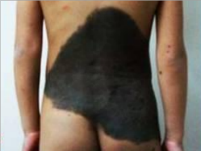 獸皮痣腰部被巨大的不規則黑斑占據圖 獸皮痣腰部被巨大的不規則黑斑占據圖