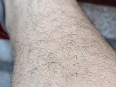 醫源性多毛症小腿汗毛很硬又黑又長圖 醫源性多毛症小腿汗毛很硬又黑又長圖