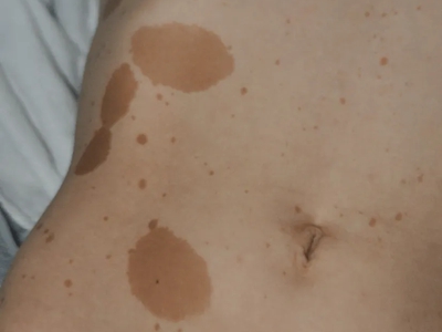 咖啡斑肚子上有多個圓形的深棕色斑圖 咖啡斑肚子上有多個圓形的深棕色斑圖