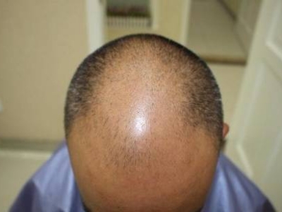 男性型脫髮髮際線後移頭頂頭髮稀疏圖 男性型脫髮髮際線後移頭頂頭髮稀疏圖