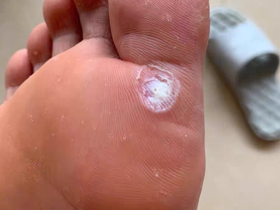 胼胝大腳趾根有個掉了皮的白色硬塊圖 胼胝大腳趾根有個掉了皮的白色硬塊圖