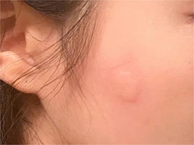 蚊子叮咬臉上起了個疙瘩圖