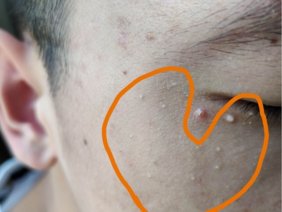 原發性粟丘疹眼周有白色小疙瘩破潰圖 原發性粟丘疹眼周有白色小疙瘩破潰圖