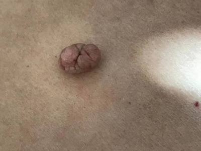 皮膚纖維瘤背部長個褐色突起的軟包圖 皮膚纖維瘤背部長個褐色突起的軟包圖