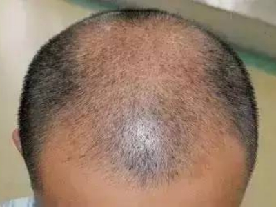 男性型脫髮髮際線上移頭頂頭髮稀疏圖 男性型脫髮髮際線上移頭頂頭髮稀疏圖