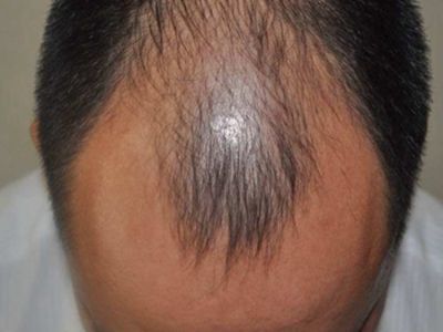男性型脫髮前額兩邊脫髮頭髮稀疏圖 男性型脫髮前額兩邊脫髮頭髮稀疏圖
