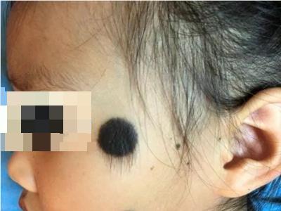 獸皮痣面部有毛髮過長的圓形黑痣圖 獸皮痣面部有毛髮過長的圓形黑痣圖