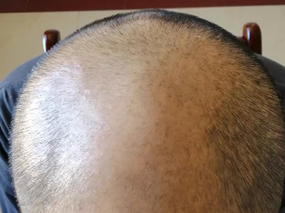 雄激素性脫髮頭頂禿了露光滑的頭皮圖 雄激素性脫髮頭頂禿了露光滑的頭皮圖