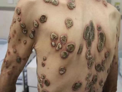 疣狀角化不良瘤後背許多扁平的疙瘩圖 疣狀角化不良瘤後背許多扁平的疙瘩圖