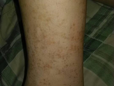 網狀肢端色素沉著小腿上有褐色斑點圖