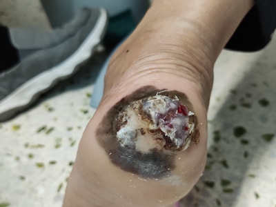 淺表播散型黑色素瘤腳後跟黑斑糜爛圖