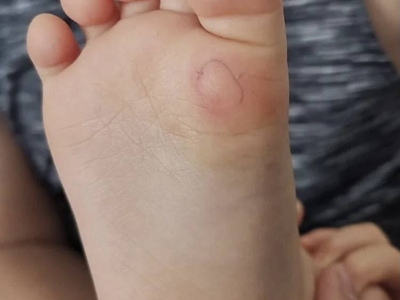 幼年跖部皮病腳底有一塊紅斑圖 幼年跖部皮病腳底有一塊紅斑圖