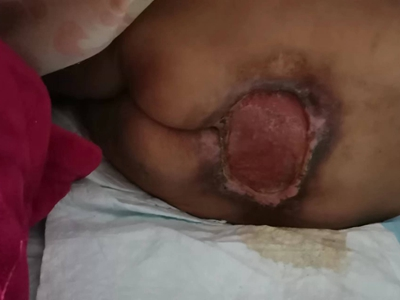 潰瘍期壓瘡臀部出現拳頭大小的潰瘍圖 潰瘍期壓瘡臀部出現拳頭大小的潰瘍圖
