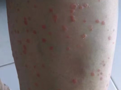 尋常型銀屑病大腿很多散在的紅色丘疹圖