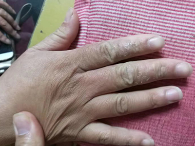 局限性神經性皮炎手指上一片片的掉皮圖 局限性神經性皮炎手指上一片片的掉皮圖