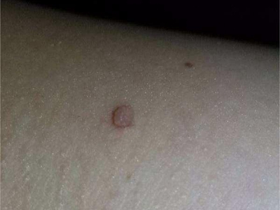 網狀組織細胞肉芽腫側頸部圓形疙瘩圖 網狀組織細胞肉芽腫側頸部圓形疙瘩圖