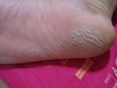溝狀跖部角質松解症腳底有好幾個坑圖 溝狀跖部角質松解症腳底有好幾個坑圖