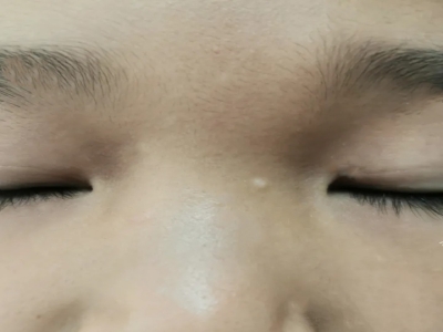 孤立性毛髮上皮瘤面部山根處有小疙瘩圖 孤立性毛髮上皮瘤面部山根處有小疙瘩圖