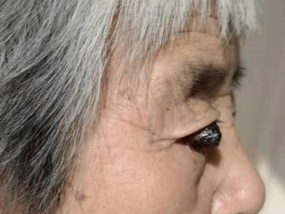 結節型黑色素瘤眼內長了個黑色腫塊圖 結節型黑色素瘤眼內長了個黑色腫塊圖