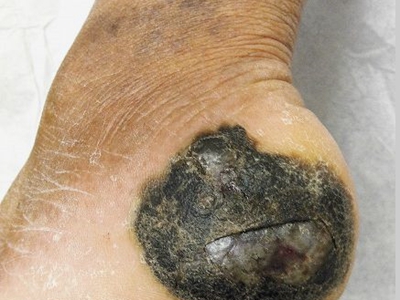愛滋病皮膚腫瘤腳後跟部有黑色斑塊圖 愛滋病皮膚腫瘤腳後跟部有黑色斑塊圖