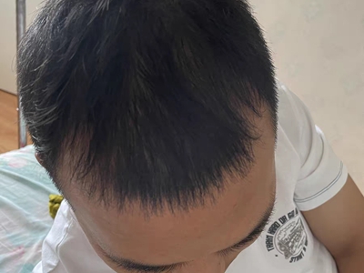 雄激素性脫髮前額兩側禿了沒有頭髮圖