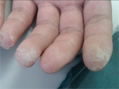 水源性肢端角化病手指尖皮膚又白又厚圖 水源性肢端角化病手指尖皮膚又白又厚圖