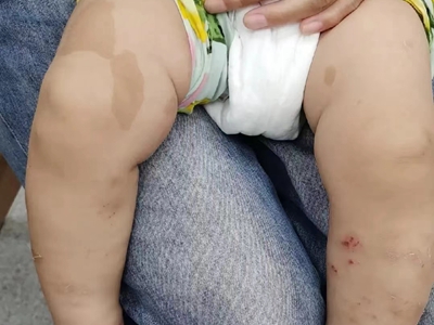 咖啡斑大腿上有分界清楚的咖啡色斑片圖 咖啡斑大腿上有分界清楚的咖啡色斑片圖
